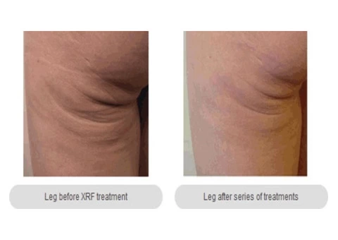 Skin Tightening Melbourne - Anti Aging Cosmetic Clinic