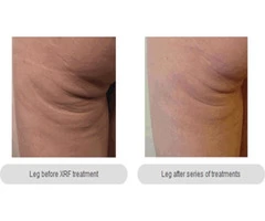 Skin Tightening Melbourne - Anti Aging Cosmetic Clinic