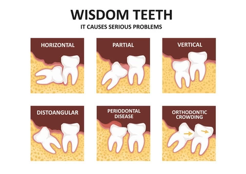 Looking For Impacted Wisdom Teeth Extraction