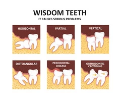 Looking For Impacted Wisdom Teeth Extraction