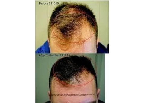 Rejuvenate hair follicles with hair treatment in Adelaide
