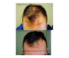 Rejuvenate hair follicles with hair treatment in Adelaide