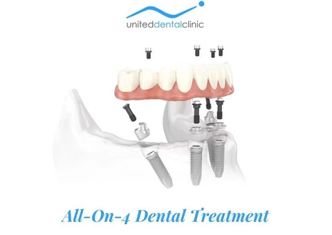 Why to Choose All-On-4 Dental Implants? United Dental Clinic