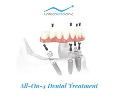 Why to Choose All-On-4 Dental Implants? United Dental Clinic