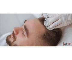 Los Angeles Hair Transplants