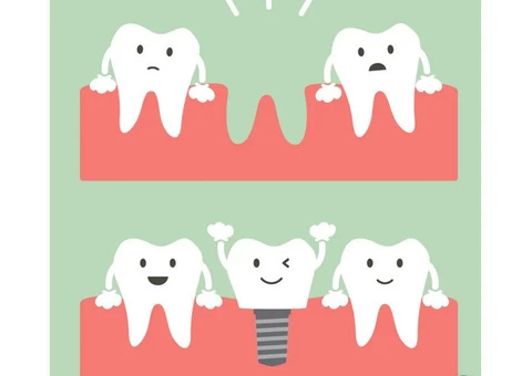 Tooth Implants - My Gentle Dentist