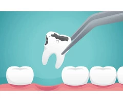 Tooth Removal and Extraction – My Gentle Dentist Arana Hills North Brisbane