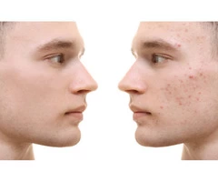 Medi Facial Treatment Coogee