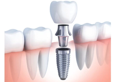 Get Tooth Decay Filling