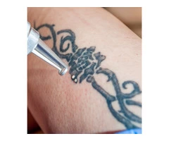 best laser hair removal clinic newcastle