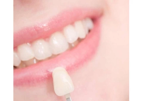 Find Affordable Porcelain Veneers for a Better Smile - 1/4