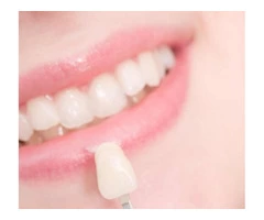 Find Affordable Porcelain Veneers for a Better Smile