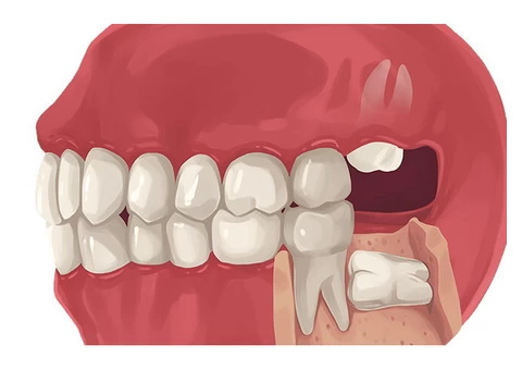 Are you worried about wisdom tooth removal pain?