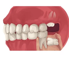 Are you worried about wisdom tooth removal pain?