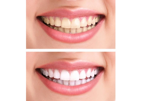 Consider Porcelain Veneers In Caulfield to Improve Your Overall Performance