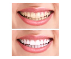 Consider Porcelain Veneers In Caulfield to Improve Your Overall Performance