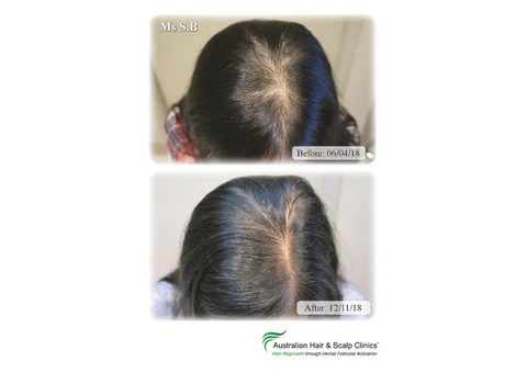 Affordable Hair Care Treatments at Aushair