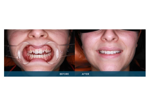 Understanding the Basics of Porcelain Veneer Services - 3/4