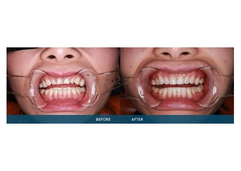 Understanding the Basics of Porcelain Veneer Services - 4/4