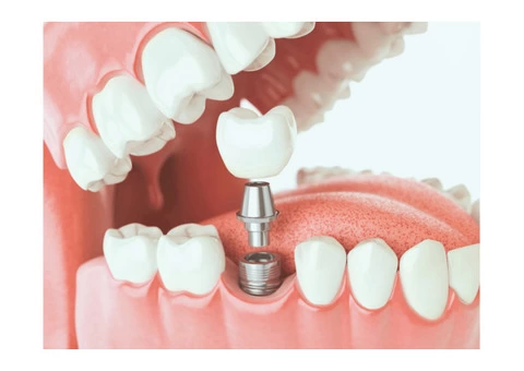 Best Dental Implants Treatment in Brisbane - Toombul Smiles Dental Clinic - 3/4