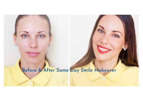 Dental Crowns – Composite Veneers