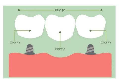 Tooth Crown – Crown for Teeth Cost