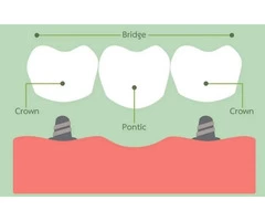 Tooth Crown – Crown for Teeth Cost
