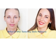 Cosmetic Dental Crown Procedure – Cosmetic Treatment