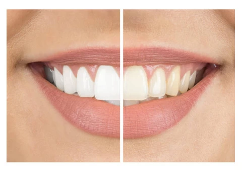 Get Dazzling Smile With Tooth Whitening by Epping Dentist - 2/2