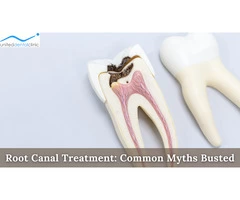 Root Canal Treatment: Common Myths Busted