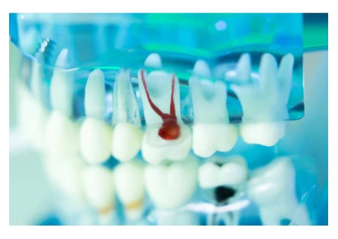 Affordable High-Quality Root Canal Treatment Melbourne CBD by Experienced Dentists - 1/3