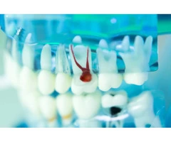 Affordable High-Quality Root Canal Treatment Melbourne CBD by Experienced Dentists