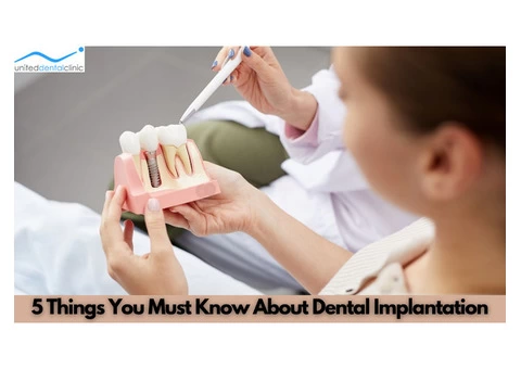 5 Things You Must Know About Dental Implantation