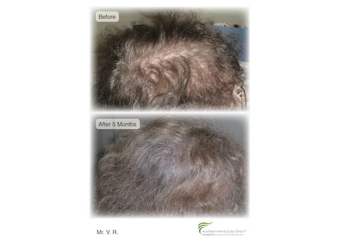 Get the hair loss treatment in Perth without any side effects