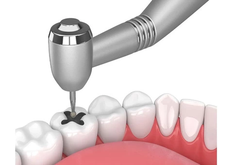 Dental Filling Services in Springvale