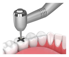 Dental Filling Services in Springvale