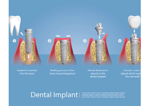 Replace Missing Teeth With Dental Implants in Donvale - 2/2