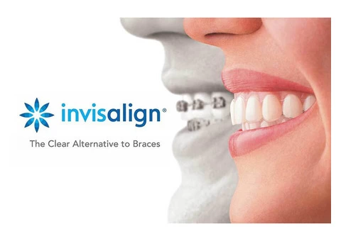 Affordable Invisalign Treatment Brisbane - Toombul Smiles Dental Clinic - 1/3