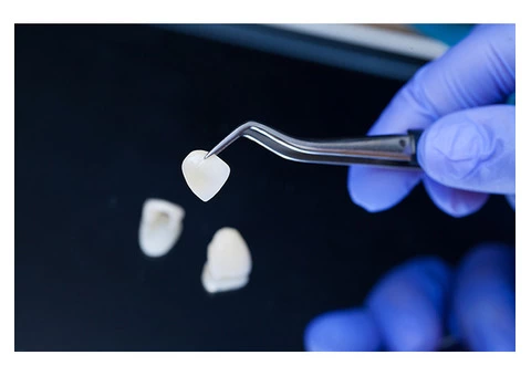Get Affordable Porcelain Dental Veneers for a Better Smile - 2/3