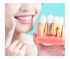 Get the Best Dental Implants Treatment From the Well-experienced Dentists