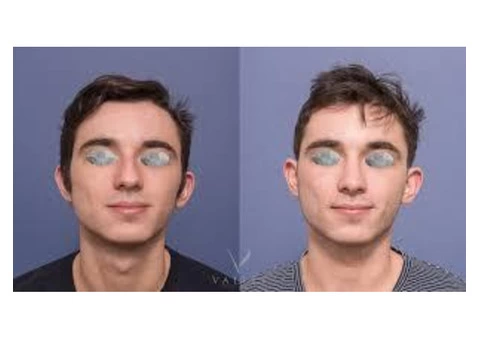 Rhinoplasty