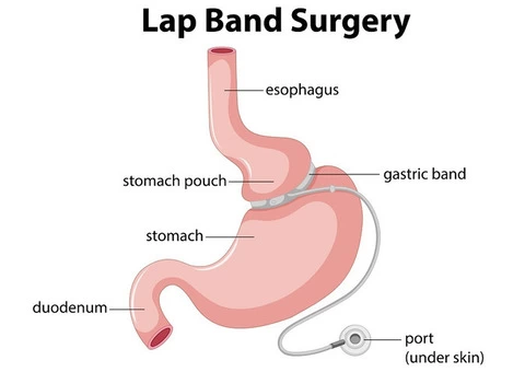Lap Band Surgery Melbourne
