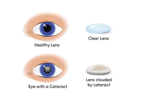 Cataract Surgery is Now Easy in Melbourne