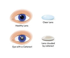 Cataract Surgery is Now Easy in Melbourne