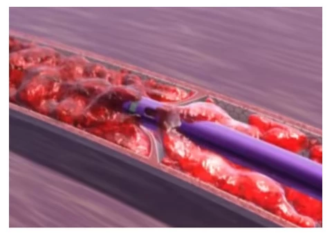 Guide to DVT Treatment | Vein Artery Specialist
