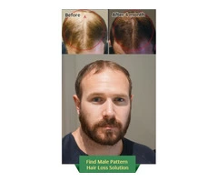 Full-proof hair loss treatment in Sydney