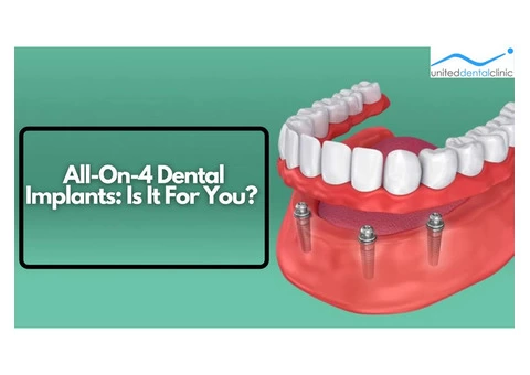All-On-4 Dental Implants: Is It For You? - 2/2