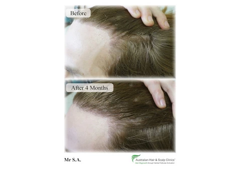 Get a quality hair treatment in Sydney for the best results