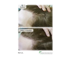 Get a quality hair treatment in Sydney for the best results