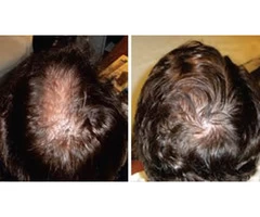 Hair loss treatment in Canberra without any side effects